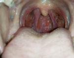 Проблемы рта: наросты, пупырышки, язвочки фото 1