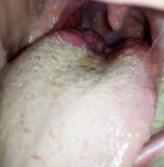 Проблемы рта: наросты, пупырышки, язвочки фото 2