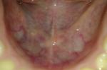 Проблемы рта: наросты, пупырышки, язвочки фото 3