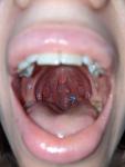 Лимфоидная ткань или папиллома горла? фото 1