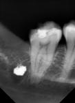 Мышьяк в зубе боли при накусывание на 2й день фото 1