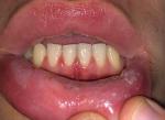 Белые пятнышки на слизистой нижней губы фото 1