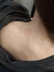 Бледный дерматит на шее и спине простая аллергия или лишай? фото 1