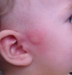 Видоизменяющееся пятно на лице у ребенка фото 2