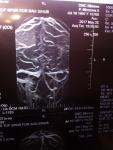 Асимметрия вен и артерий головного мозга фото 3