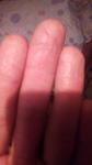 Сухость и шелушение кожи на пальца рук фото 3