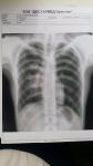 Туберкулез, пневмония? фото 1