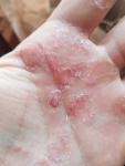 Заболевание кожи ладоней рук фото 2