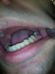 Шишка на десне нижнего зуба фото 1