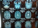 Расшифровать МРТ головного мозга фото 1
