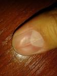 Заболевания ногтя на руке фото 2