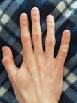 Есть ли патологии на рентгене кистей рук? фото 5