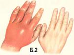 Очень красные руки и гепатит фото 1