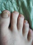 Грибок ногтя ноги парень фото 2