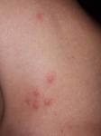 Небольшие прыщики с сильным зудом укус, аллергия или инфекция? фото 1