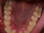 Стоматит, прыщ во рту и во внутренней стороне губы фото 2