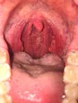 Красное горло 4 месяца. Увеличенные лимфоузлы и температура 37.1 фото 1