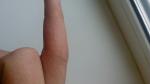 Сыпь на среднем пальце фото 1