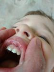 Язвы и налет во рту у ребенка фото 1