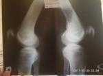Артроз коленного сустава фото 3