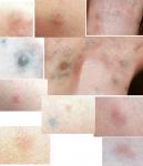 Аллергия или кожный дерматит фото 1