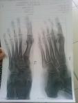 Рентген стопы мнение врача фото 3