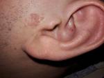 Маленький красные пупырышки в наружной части левого уха фото 2