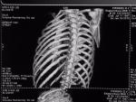 Сложный перелом рёбер, необходимость операции по остеосинтезу фото 2