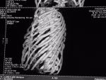 Сложный перелом рёбер, необходимость операции по остеосинтезу фото 4
