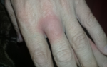 Причина воспаления среднего пальца на левой руки фото 1