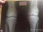 Артроз коленного сустава фото 2