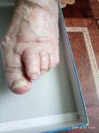 Что делать и чем лечить грибок ногтей на ноге фото 2