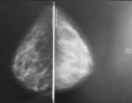 Уточнение диагноза после маммографии фото 1