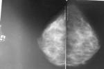 Уточнение диагноза после маммографии фото 3