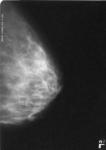 Уточнение диагноза после маммографии фото 4