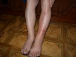 Красное пятно с бурыми на голени ноги фото 4