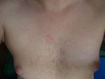 Что за высыпания на коже грудной клетки? фото 2