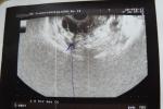 Мелкокистозные изменения правого яичника фото 1