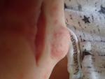 Сыпь на лице у ребенка в виде прыщиков 1 месяц фото 4