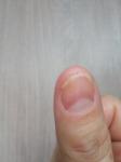 Проблемы с ногтями фото 2