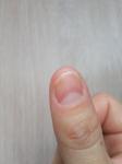 Проблемы с ногтями фото 1