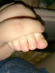 Грибок ногтей у ребенка фото 1