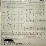 Электрокардиограмма расшифровка фото 1
