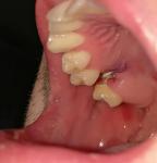 Осложнения заживление лунки после удаления зуба фото 1