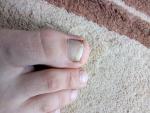 Небольшой грибок ногтя на ноге фото 1