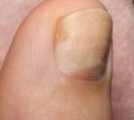 Темное пятно на ногте большого пальца ноги фото 4