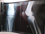 Боль в колене и рентген фото 1