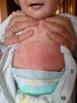 Лечение ребенка при атопическом дерматите фото 1