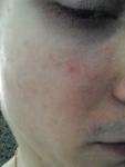 Шелушение кожи лица и за ушами красные пятна на лице фото 1