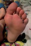 Красные подушечки пальцев на ногах фото 1